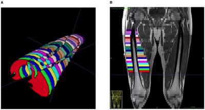The Impact of Slice Interval and Equation on the Accuracy of Magnetic Resonance Image Estimation of Quadriceps Muscle Volume in End Stage Liver Disease